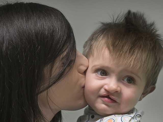 Woman kisses child with a cleft palate