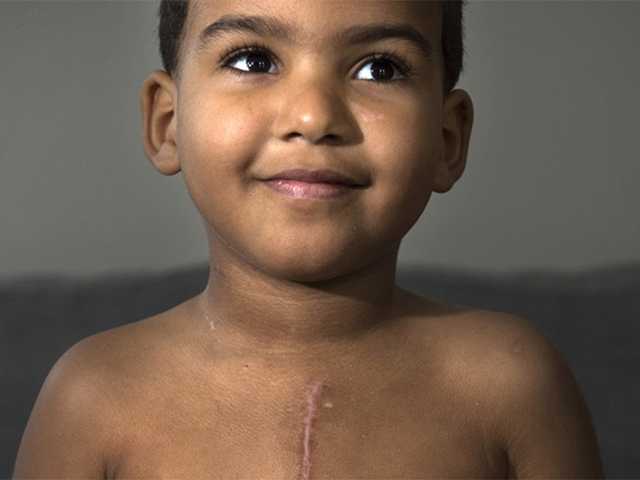 Young boy with scar on chest.